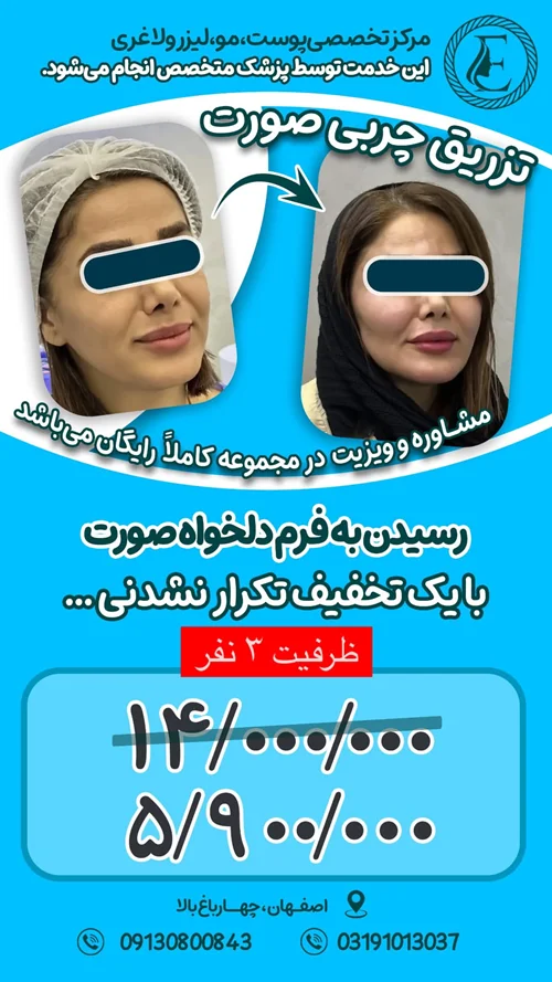 جشنواره تزریق چربی صورت